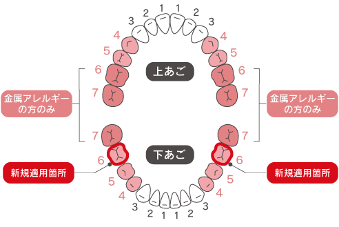 大臼歯保険CAD/CAM冠の保険適用範囲