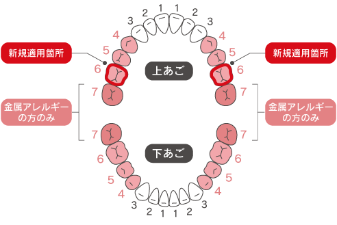 大臼歯保険CAD/CAM冠の保険適用範囲