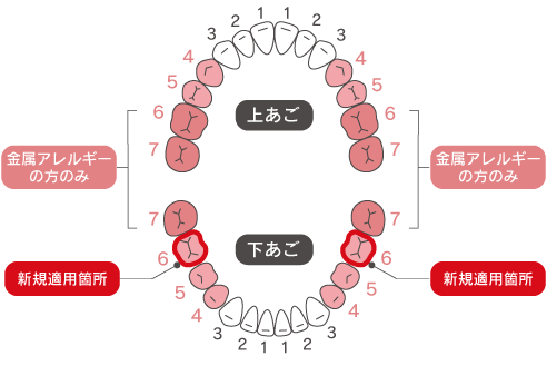 保険CAD/CAM冠(大臼歯)の適用範囲 | ワールドミリングセンター[歯科